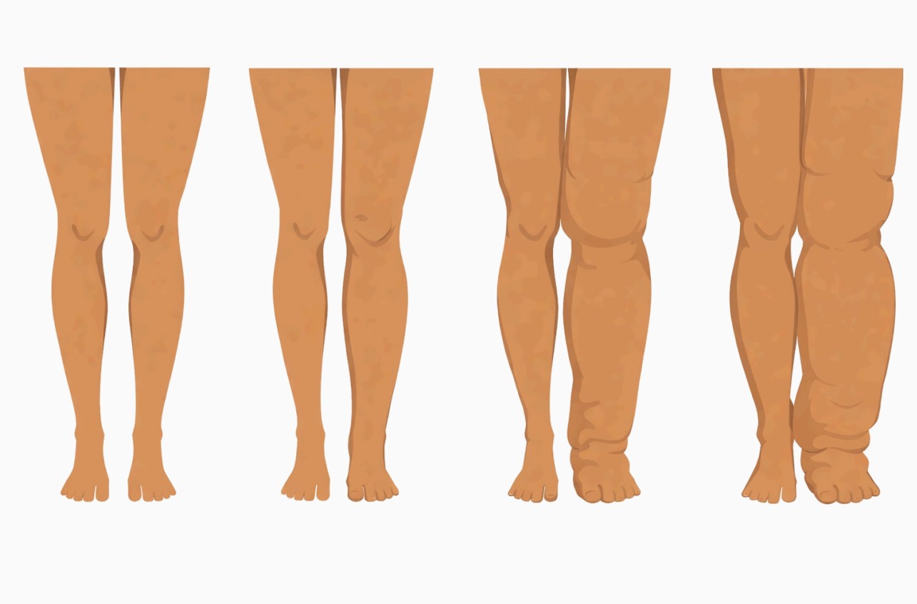 Stadia obrzęku limfatycznego