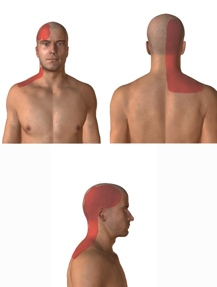 Lokalizacja bólu szyjnopochodengo