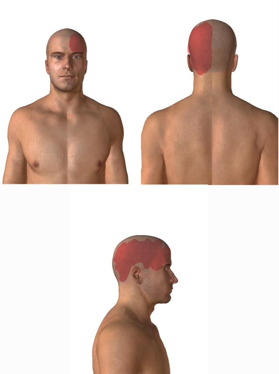 Lokalizacja migrenowego bólu głowy