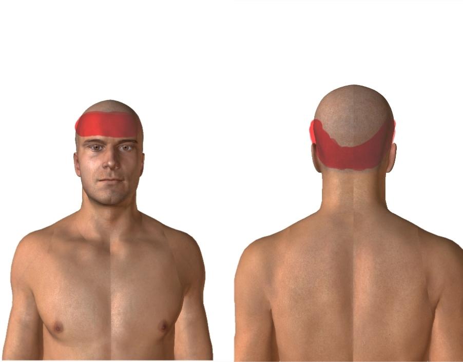 Lokalizacja napięciowego bólu głowy